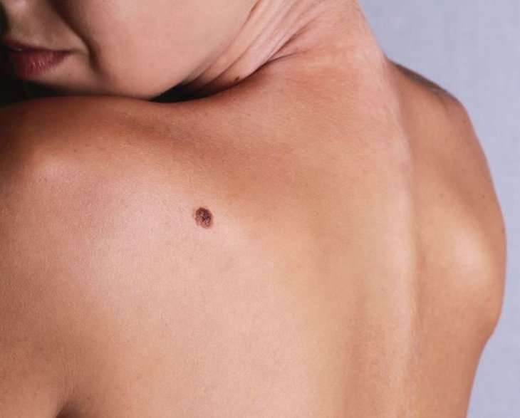 15 Signs And Symptoms Of Melanoma