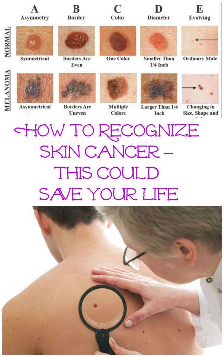 17 Best images about Squamous cell carcinoma on Pinterest ...