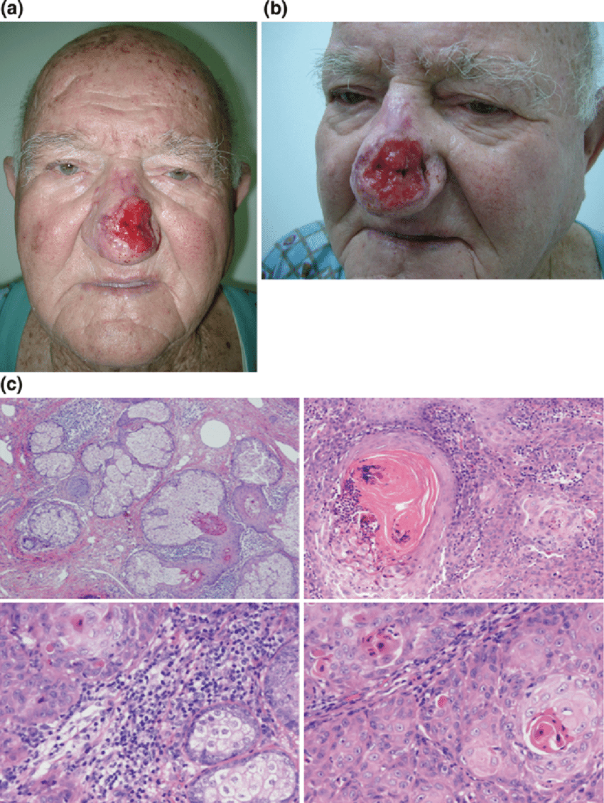 a, b Squamous cell carcinoma in a rhinophyma present for ...