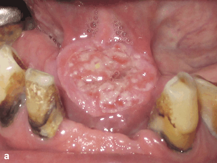 a) Oral squamous cell carcinoma in the floor of the mouth ...
