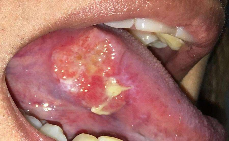 A squamous cell carcinoma of the tongue.