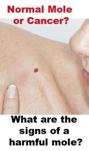 Are you panicky that your mole could be cancerous? Find ...