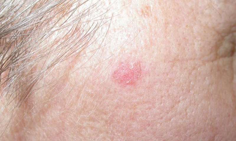 Basal Cell Carcinoma (BCC)