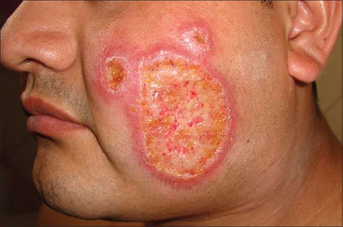 Basal Cell Carcinoma Home Remedy and other natural treatment