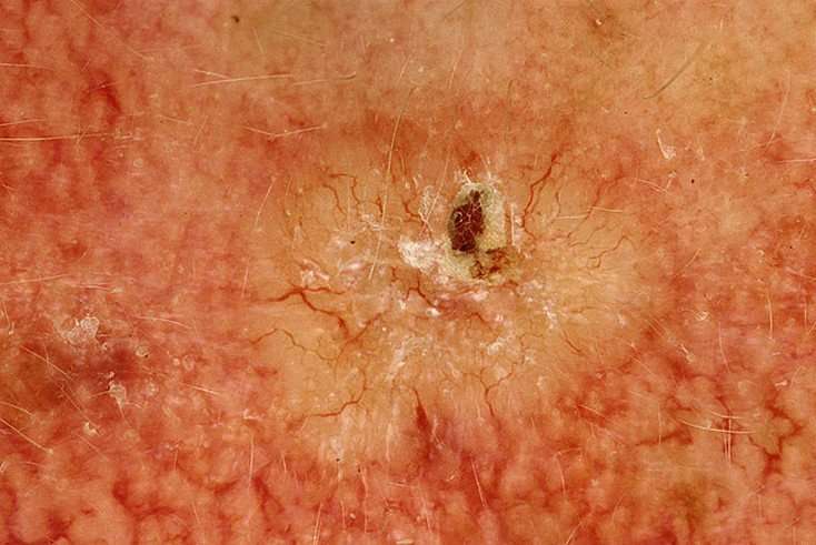 Basal Cell Carcinoma Pictures  54 Photos &  Images ...