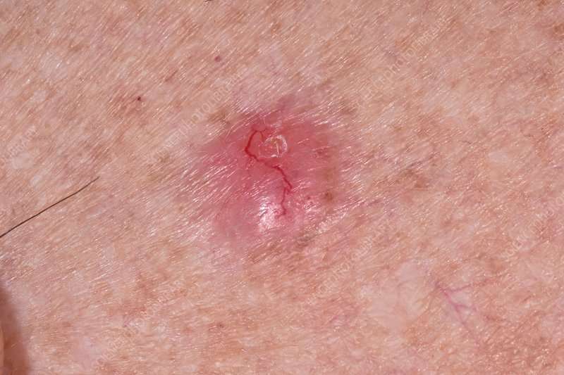 Basal cell carcinoma skin cancer