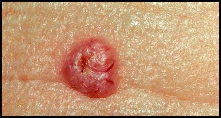 Basal Cell Carcinoma: Skin Cancer, Symptoms, Causes, Treatment