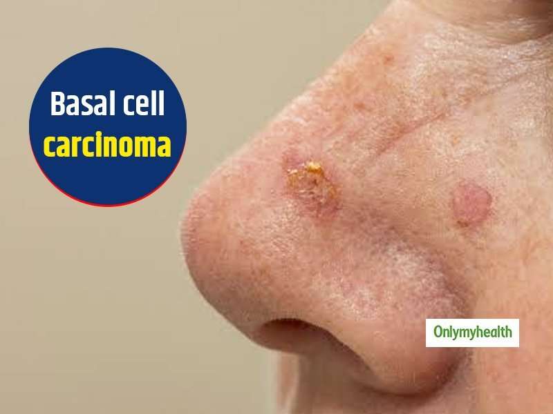 Basal Cell Carcinoma: Symptoms, Causes And Treatment By ...