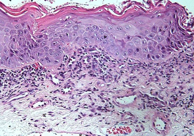 Bowenoid Papulosis (Penile Intraepithelial Neoplasia ...