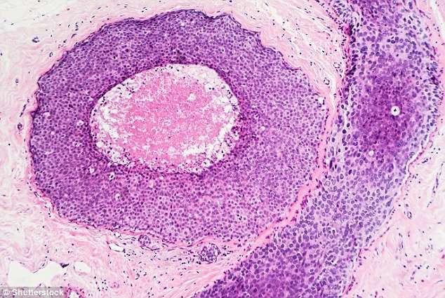 Breast cancer cells start spreading to other parts of the ...