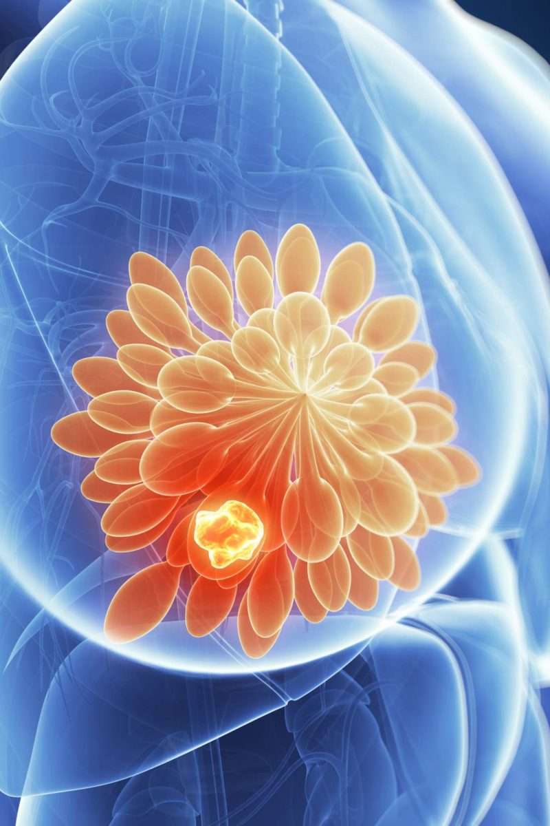 Breast cancer: Tumor growth fueled by bone marrow cells