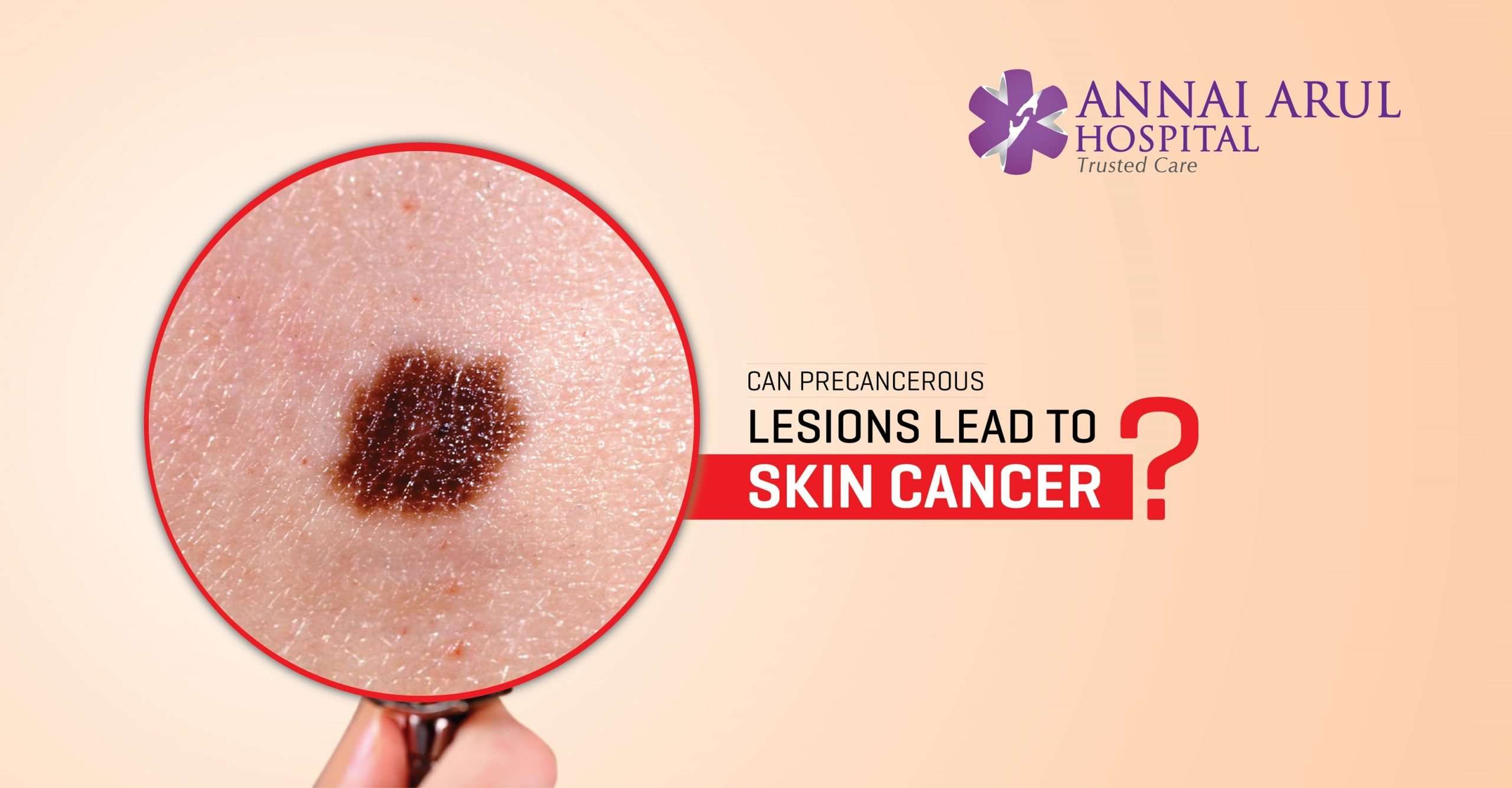 CAN PRECANCEROUS LESIONS LEAD TO SKIN CANCER ...