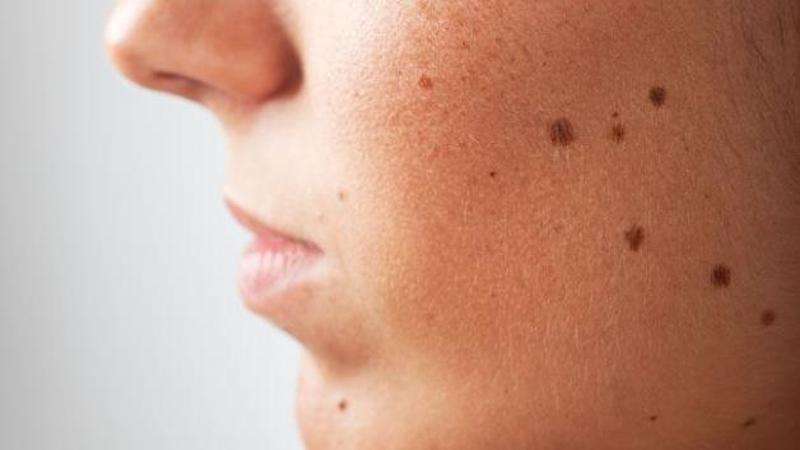 Can Skin Moles Develop Into Cancerous Growths?