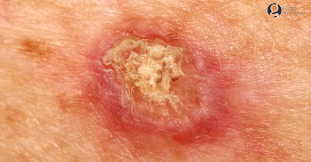 Can Squamous Cell Carcinoma Spread