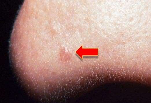 Can You Recognize Benign Skin Lesions From Cancerous Ones?