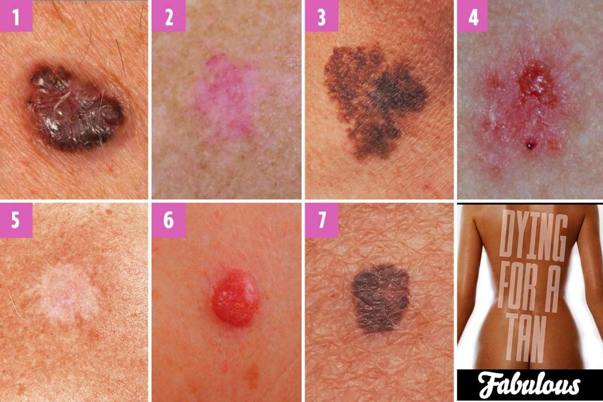 Can you spot which moles are deadly? The skin cancer signs ...