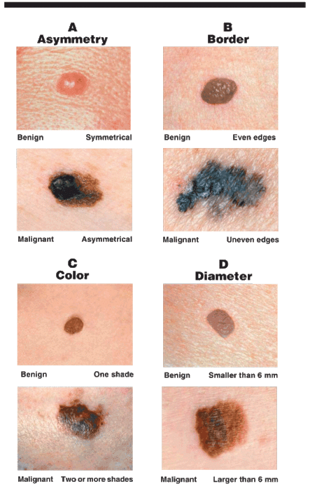 Characteristics of cancerous moles (OP) ~ good to know. I ...