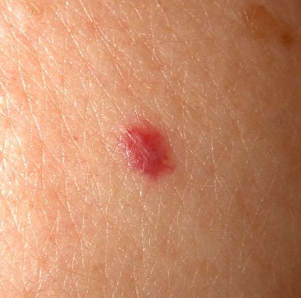 Cherry Angioma Causes, Pictures, Bleeding, Treatment &  Removal