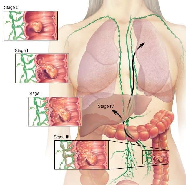 Colon Cancer Stages : Many Canadians Diagnosed With ...