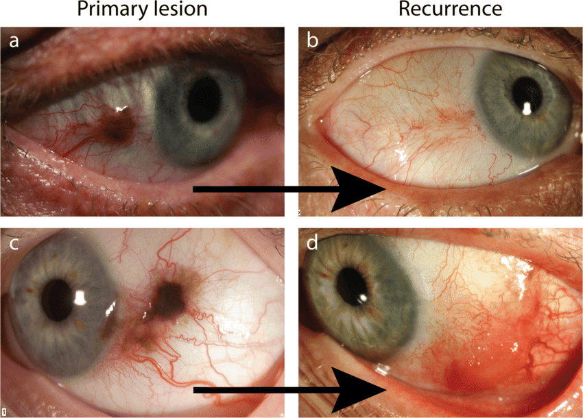 Corresponding primary and recurrent lesions of ...