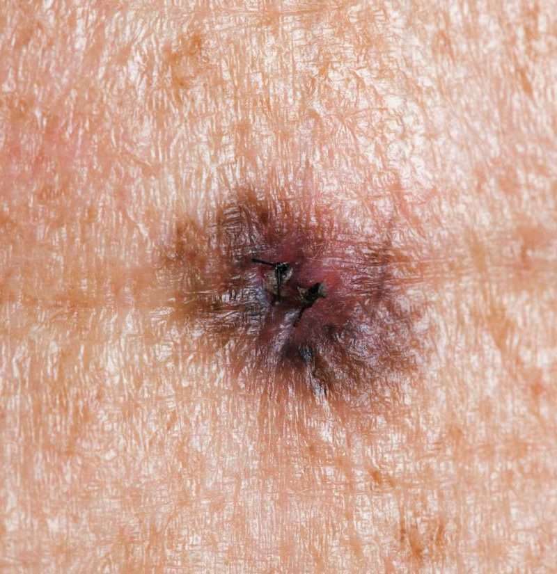 Deadly skin cancer could be halted with arthritis drug