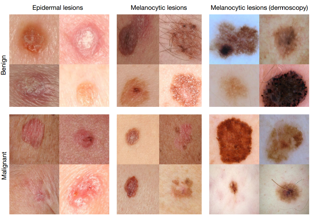 Deep learning algorithm diagnoses skin cancer as well as ...