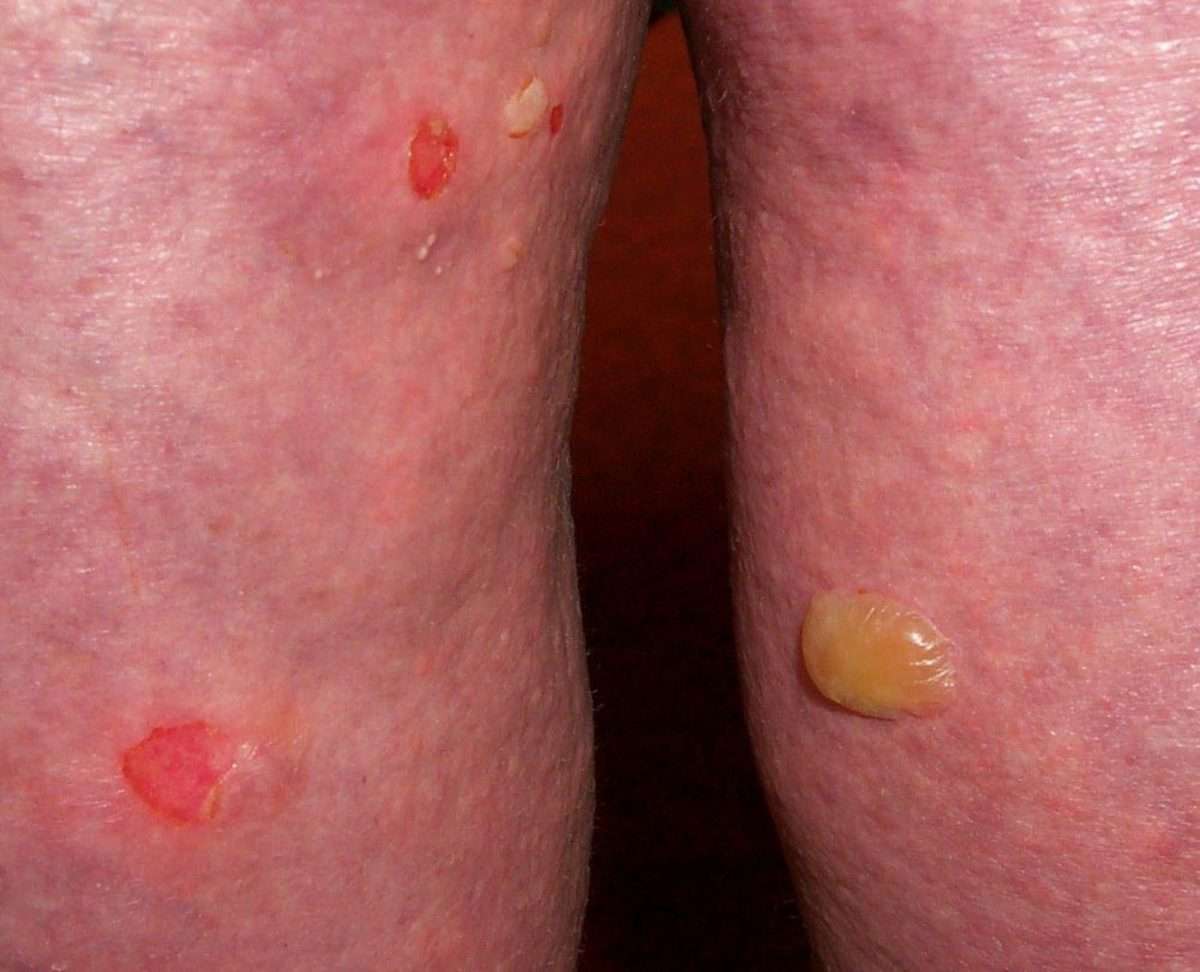 Derm Dx: Skin Blisters and Erosion in an Elderly Woman