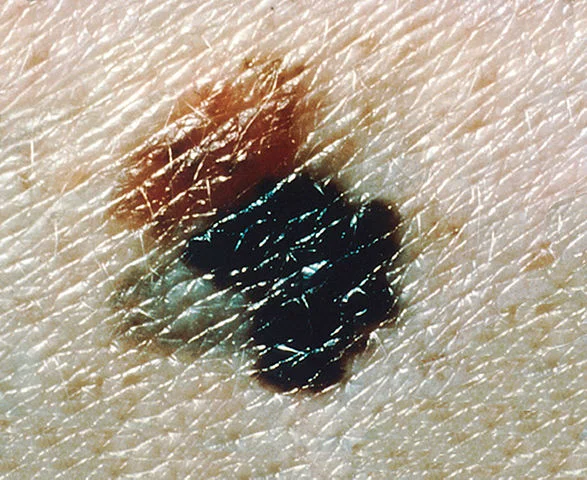 Difference between Blood blister and Melanoma