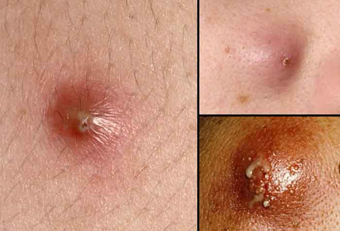 Difference between herpes and ingrown hair