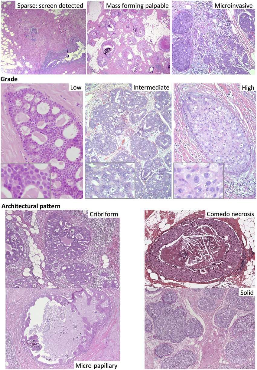 different subtypes of ductal carcinoma in situ