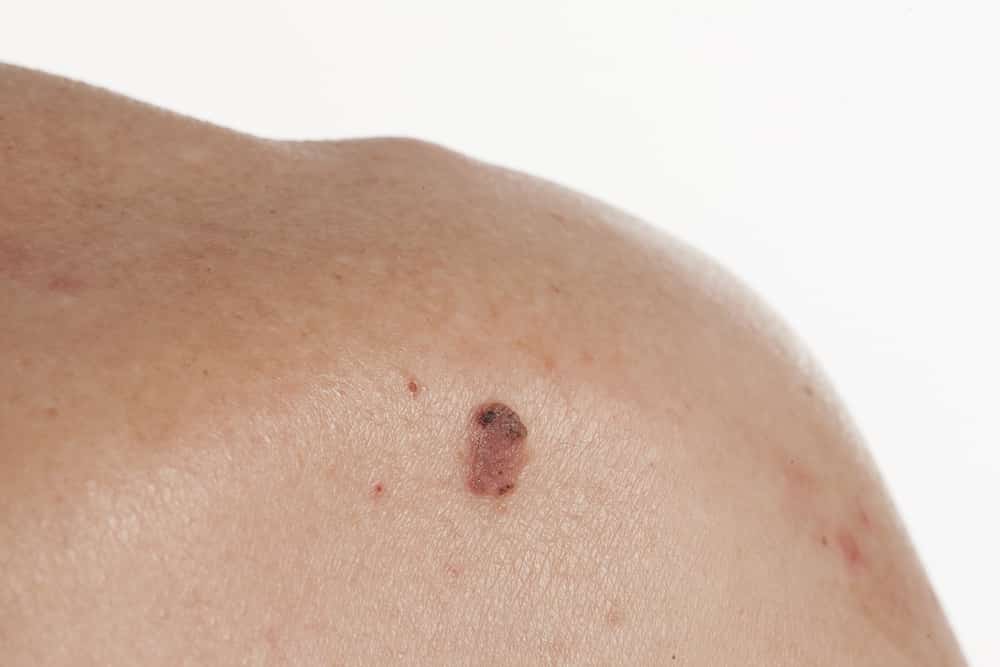 Different Types of Skin Cancer: What to Look For
