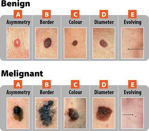 Do ABCDEs Always Apply to Melanoma  Can Cancer Look Normal ...