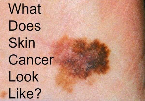 Do You Know What Skin Cancer Looks Like? â Bath and Body