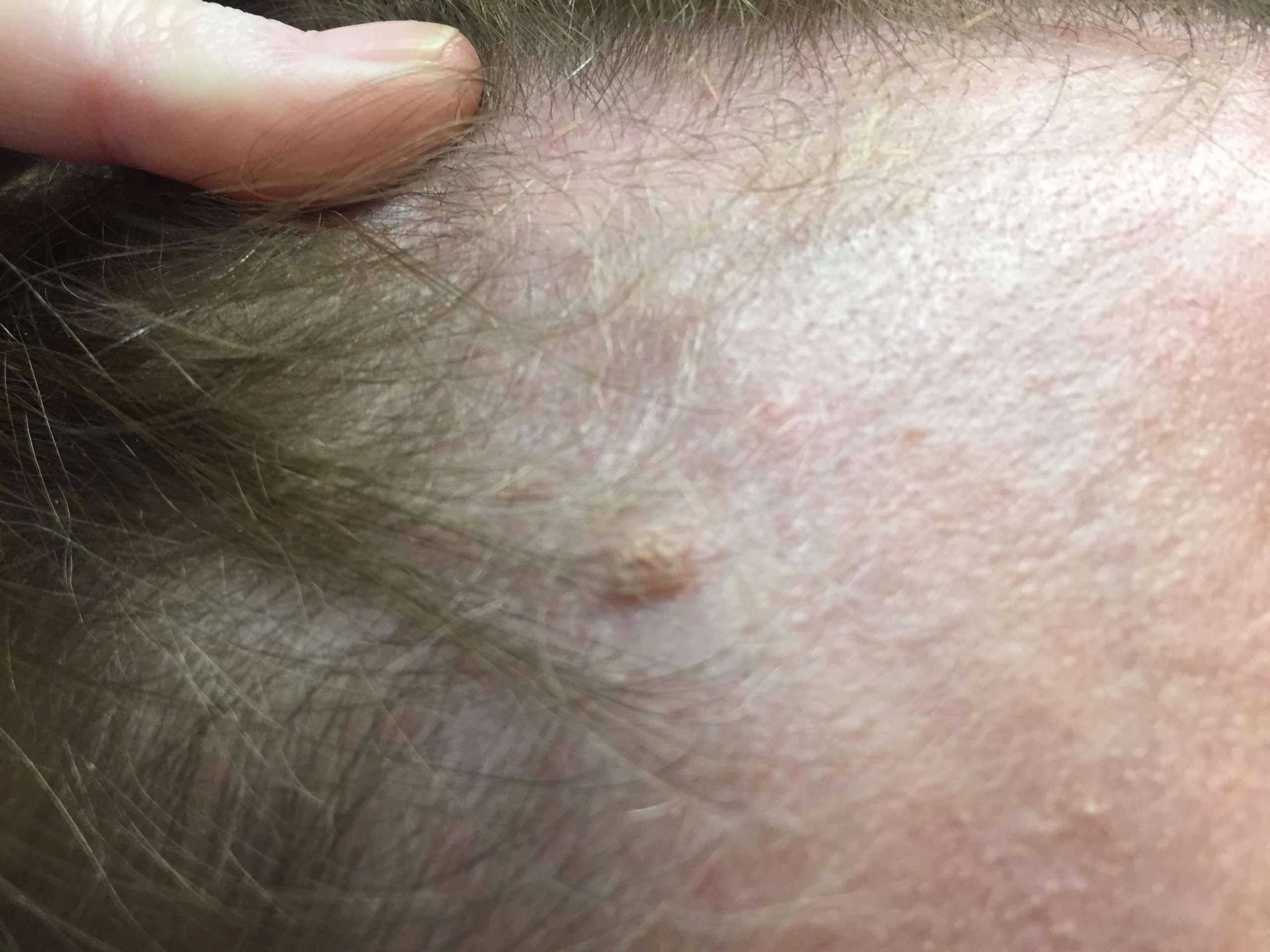 Does this look like basal cell carcinoma? : Dermatology