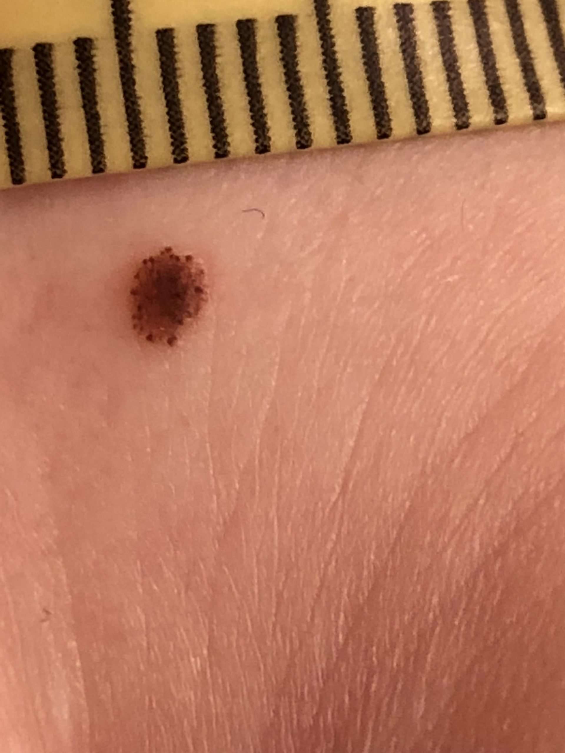 Does this look like melanoma? It has gotten darker and ...