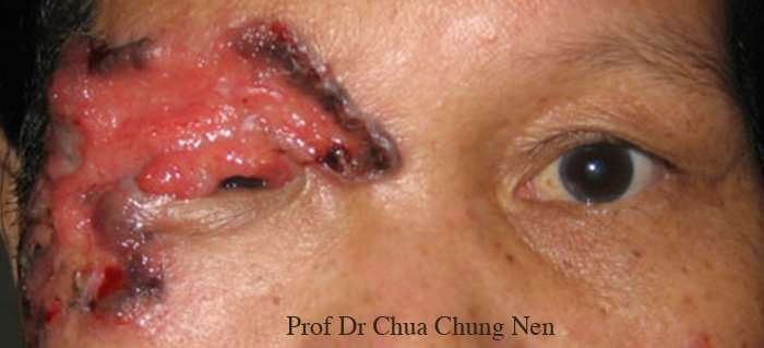 Eyelid Surgery by Prof Dr CN CHUA è¡é?è½: Doc, what is this ...