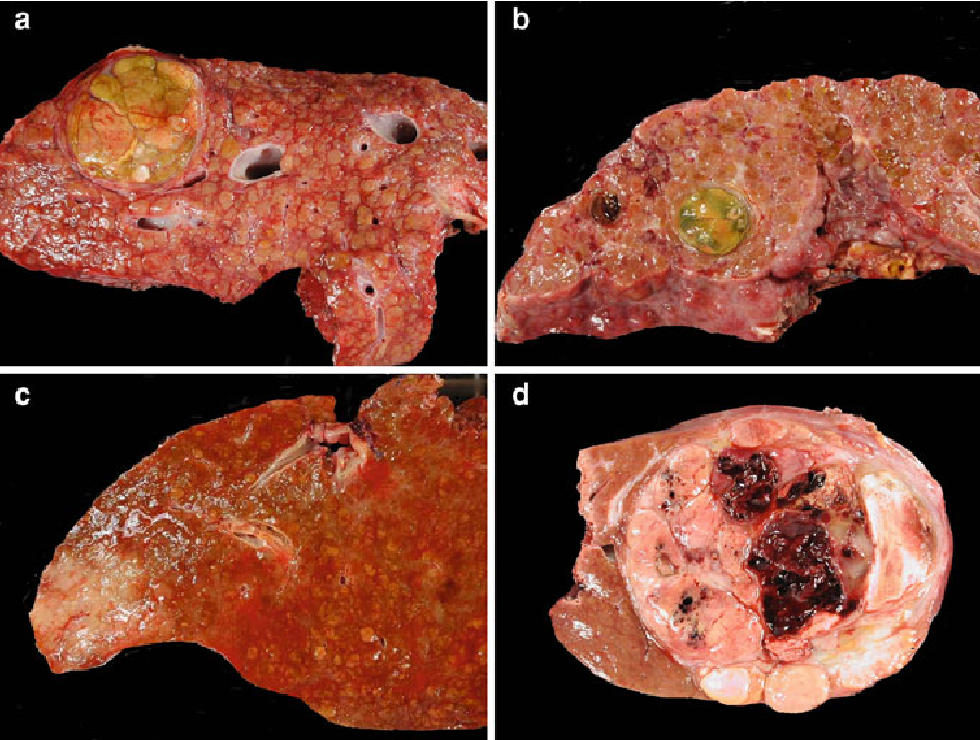 Figure 1 from Histopathology of hepatocellular carcinoma.