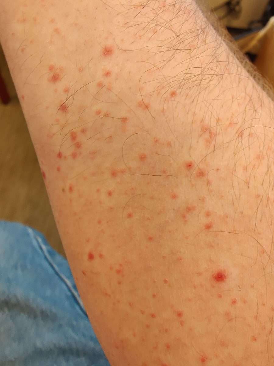 Got this red spots on my arms about 10