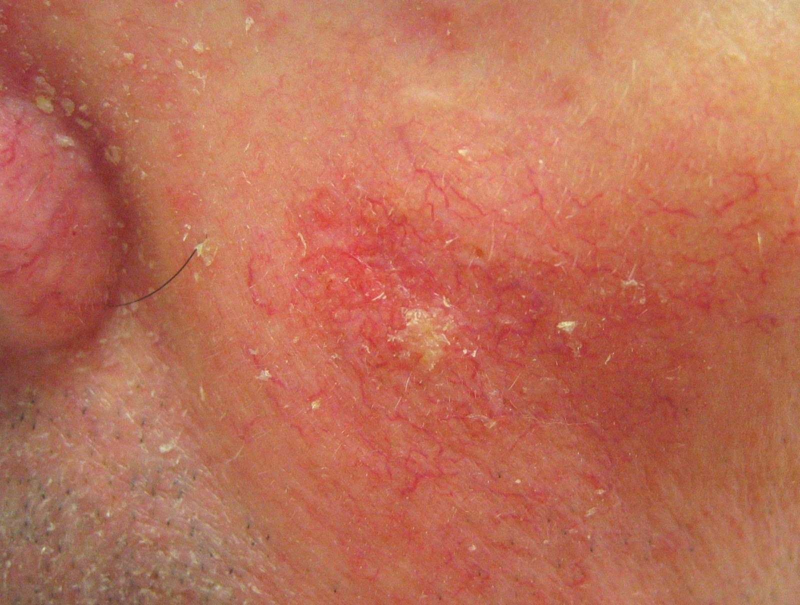 HEALTH FROM TRUSTED SOURCES: Squamous Cell Carcinoma of ...