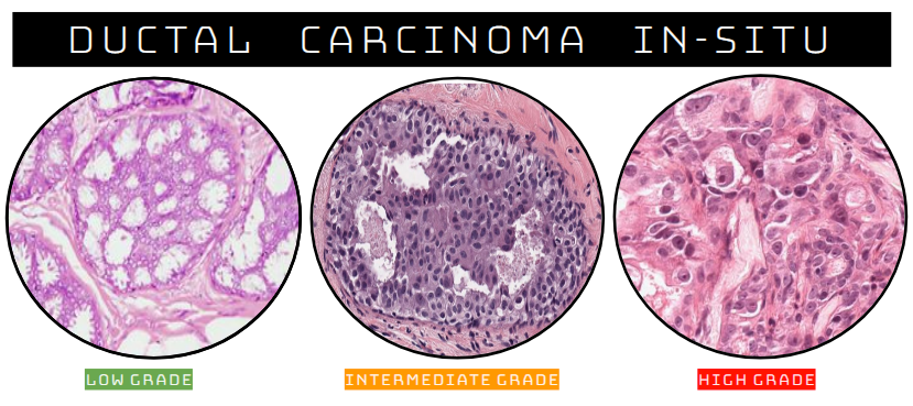 High Yield Breast Pathology: Ductal Carcinoma in