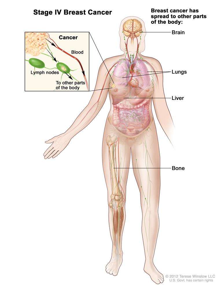How Do You Know If Breast Cancer Has Spread To Lymph Nodes ...