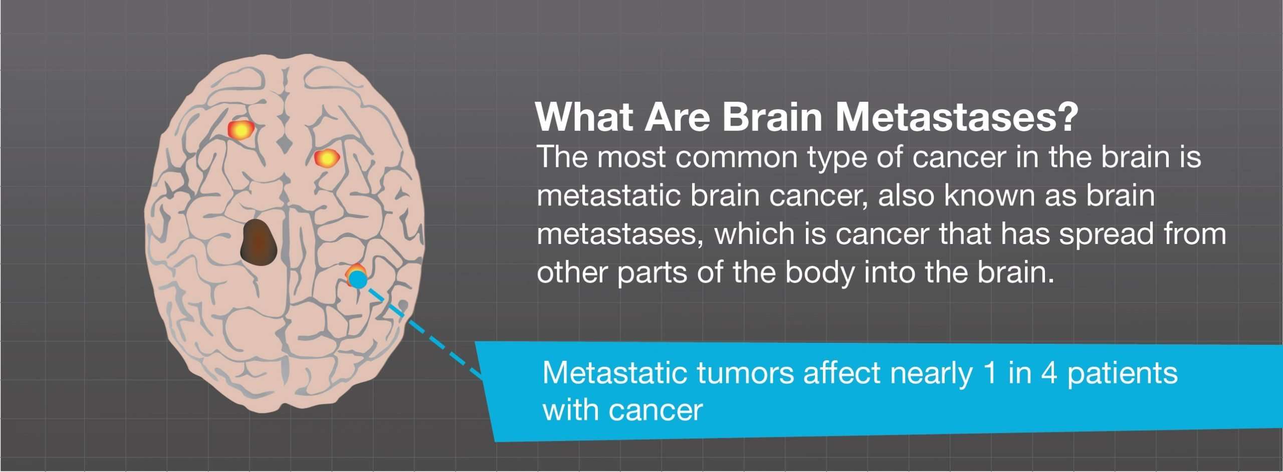 How long can you live with metastatic brain cancer ...
