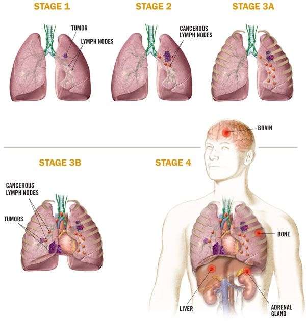 How Many Stages Are There In Lung Cancer