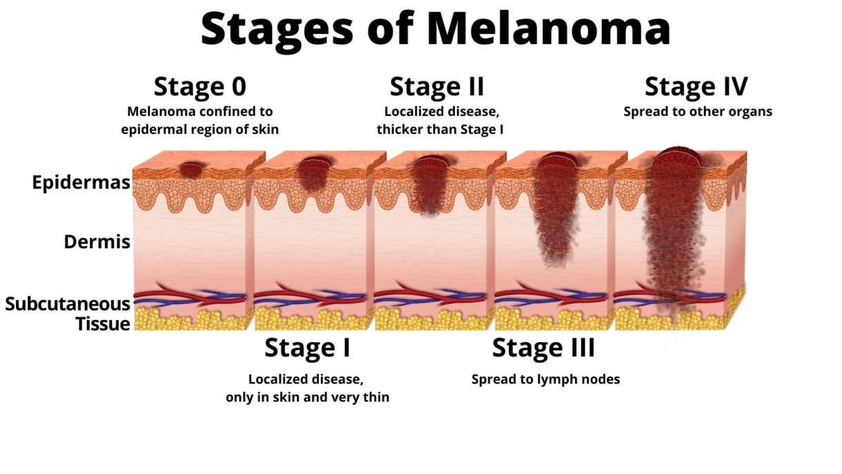How Quickly Does Melanoma Grow : Once its in the organs ...
