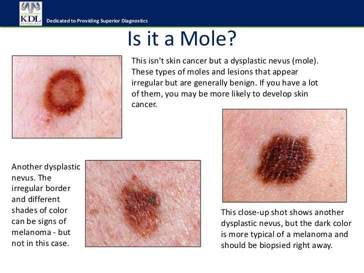 How To Know If You Have A Skin Cancer / How To Tell If You ...
