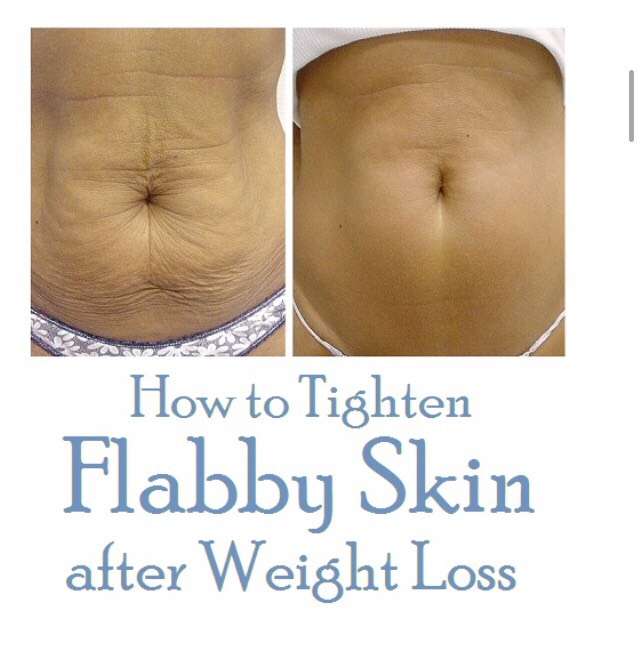 HOW TO TIGHTEN FLABBY SKIN AFTER WEIGHT LOSS!