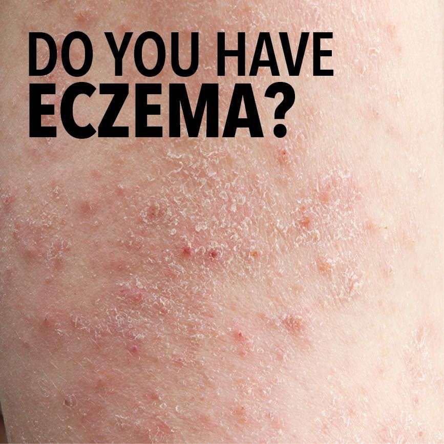 If you have dry, itchy and rough skin, you may have eczema ...