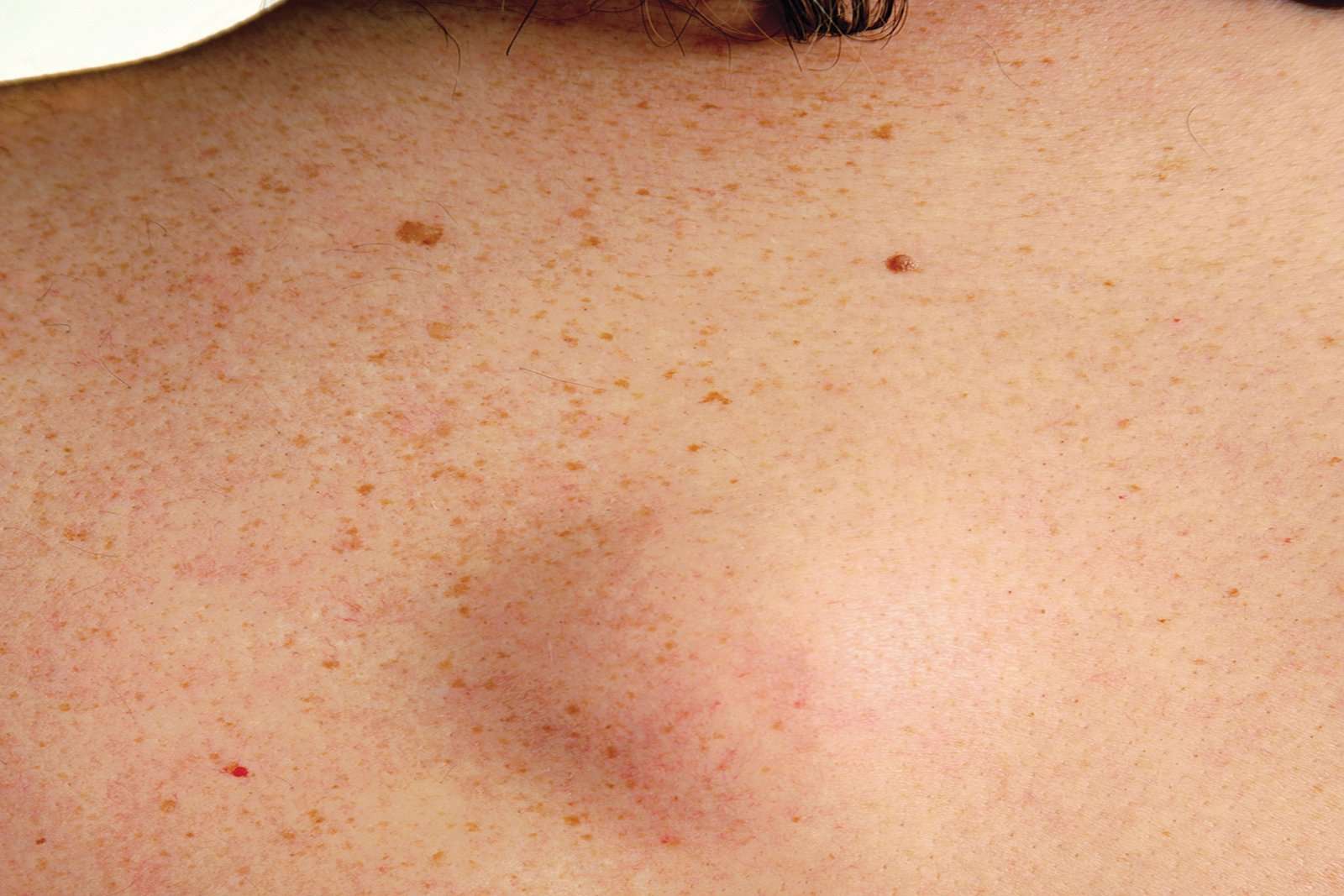 Images Of Skin Cancer On Your Back