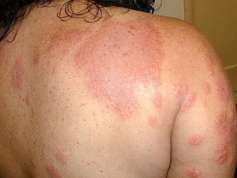 Itchy Skin No Rash Cancer : lymphoma