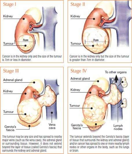 Kidney Cancer, Symptoms, Types, Treatment and Prevention ...